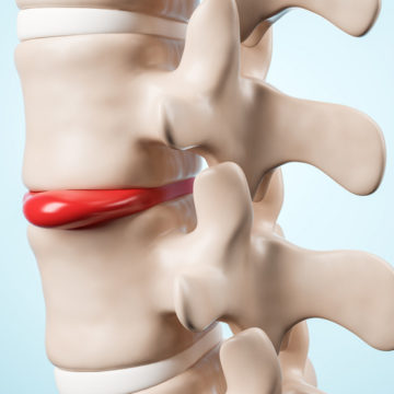 Лечение позвоночной грыжи в МЦ «Гармония»