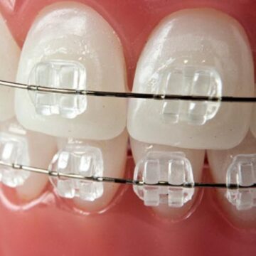 Преимущества сапфировых брекетов